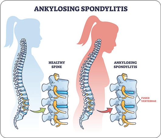 Spondylitis Treatment - Dr Chavan Hospital