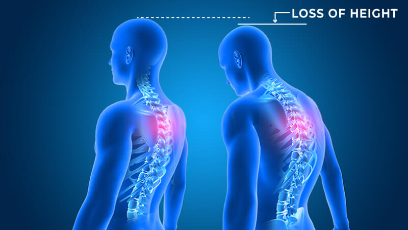 Loss of Height Treatment - Dr Chavan Hospital Nashik