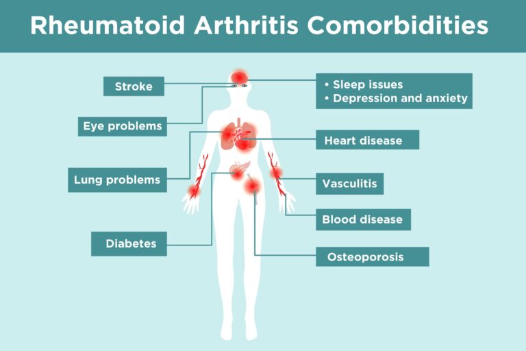 Primary Care Rheumatology – SLE & Various Arthriti