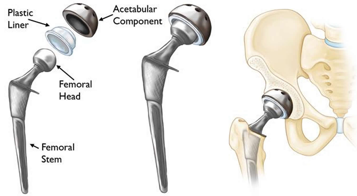 Hip Replacement Surgery - Dr Chavan Hospital Nashik