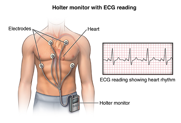 Holter Monitoring