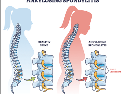 Spondylitis Treatment - Dr Chavan Hospital
