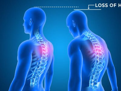 Loss of Height Treatment - Dr Chavan Hospital Nashik