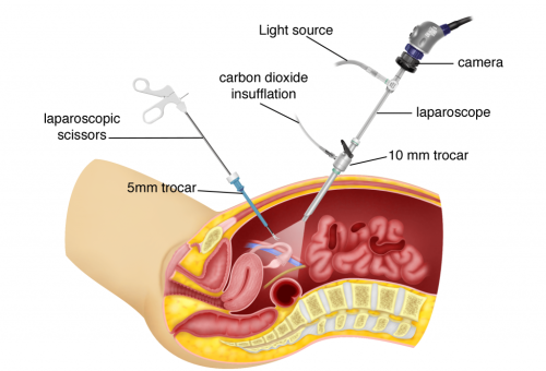Figure-15.5-How-is-laparoscopic-surgery-performed-1024×819 Laparoscopic Surgery - Dr Chavan Hospital Nashik