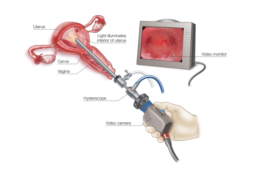 Picture-1-2 Hysteroscopy Surgery - Dr Chavan Hospital Nashik