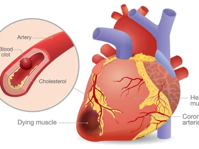 heart attack illustration Heart Attack - Dr Chavan Hospital Nashik