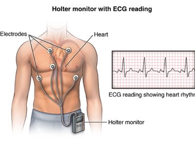 Front view male figure torso with holter monitor and ekg/heart rhythm inset Holter Monitoring