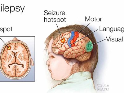medical-illustration-of-a-brain-with-epilepsy-a-seizure-hotspot-and-the-motor-language-and-visual-areas-original-1 Neurological Illness – Epilepsy / Stroke